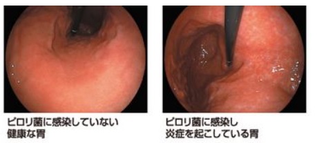 ピロリ 菌 除去 後